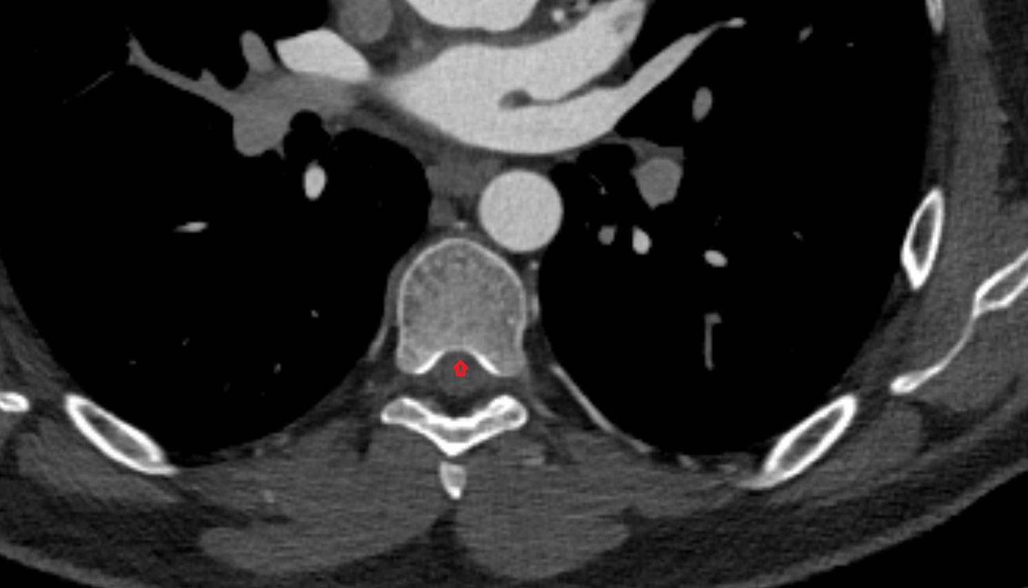 Posterior longitudinal ligament ct axial  image -img-00000-00000