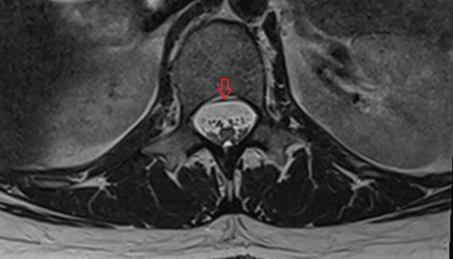 Posterior longitudinal ligament  mri axial  image -img-00000-00000