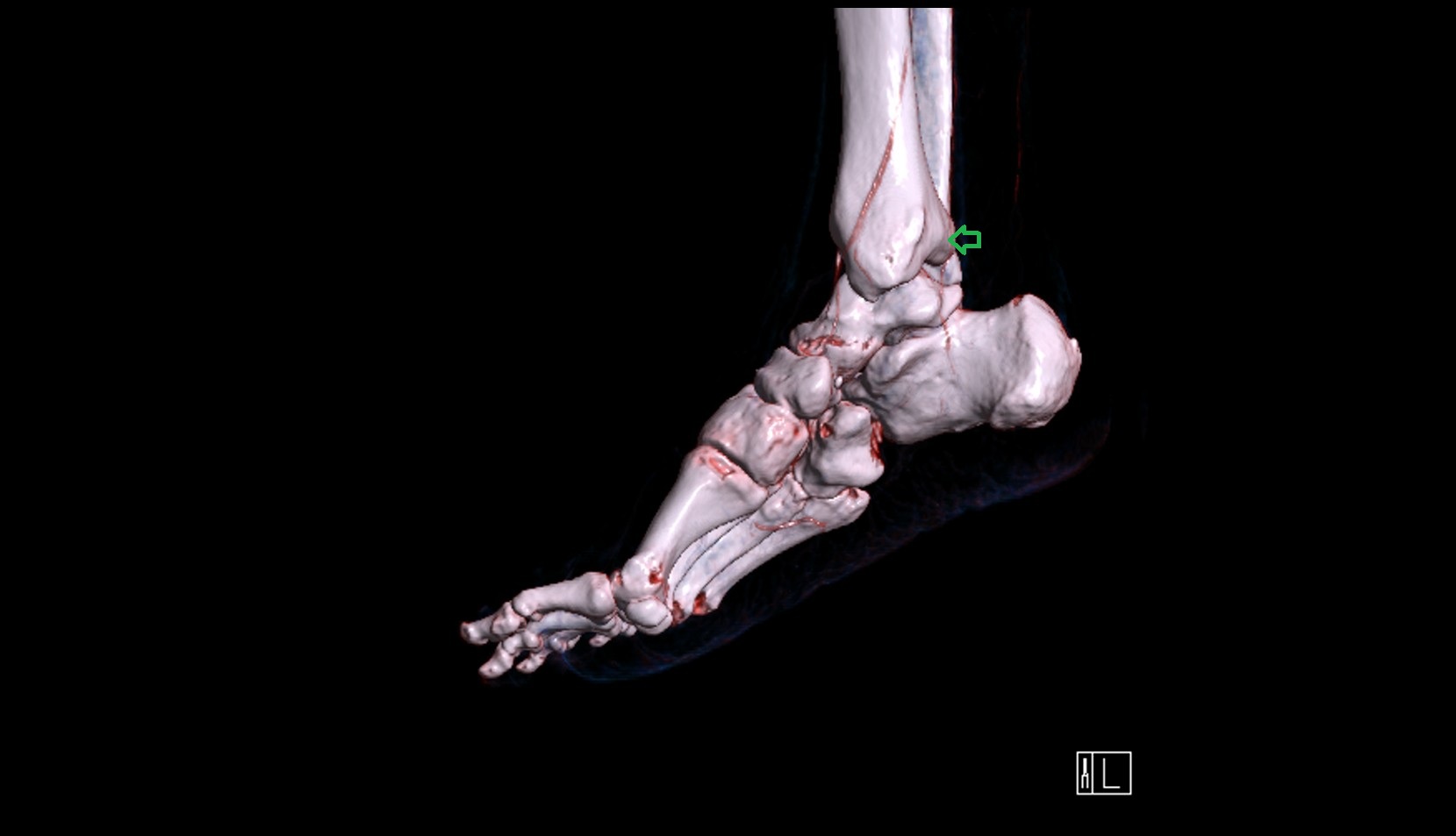 Posterior malleolus 3d