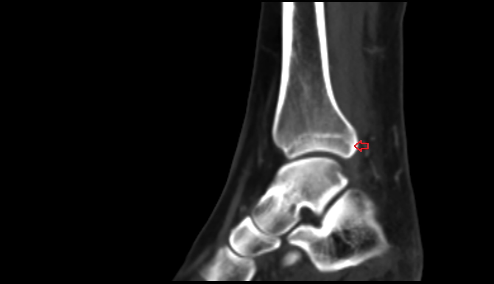 Posterior malleolus ct sag image