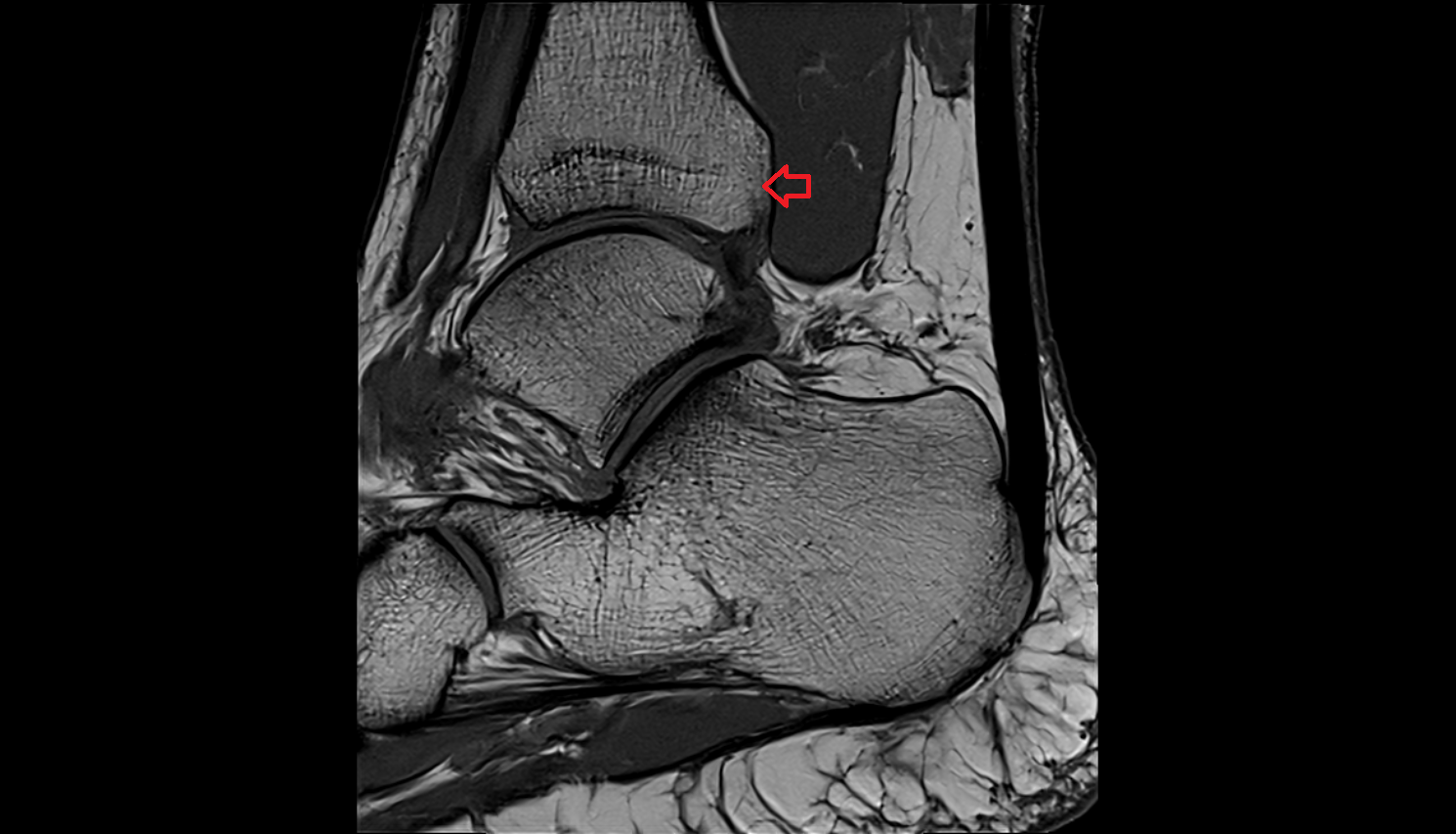 Posterior malleolus mri  anatomy labelled image-img-00000-00000