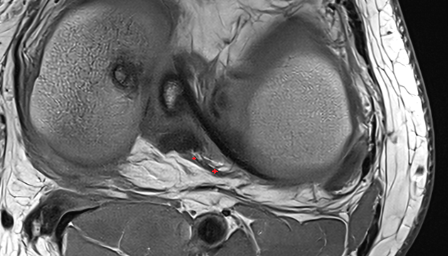 Posterior meniscofemoral ligament (Wrisberg)  axial cross sectional anatomy 3T MRI AI enhanced  radiology  anatomy image-img-00000-00000