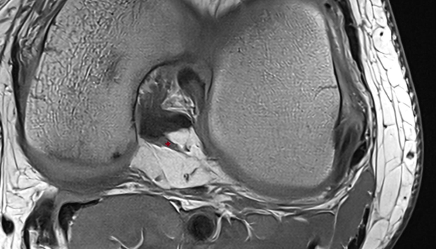 Posterior meniscofemoral ligament (Wrisberg)  axial cross sectional anatomy 3T MRI AI enhanced  radiology  anatomy image-img-00000-00000_00001