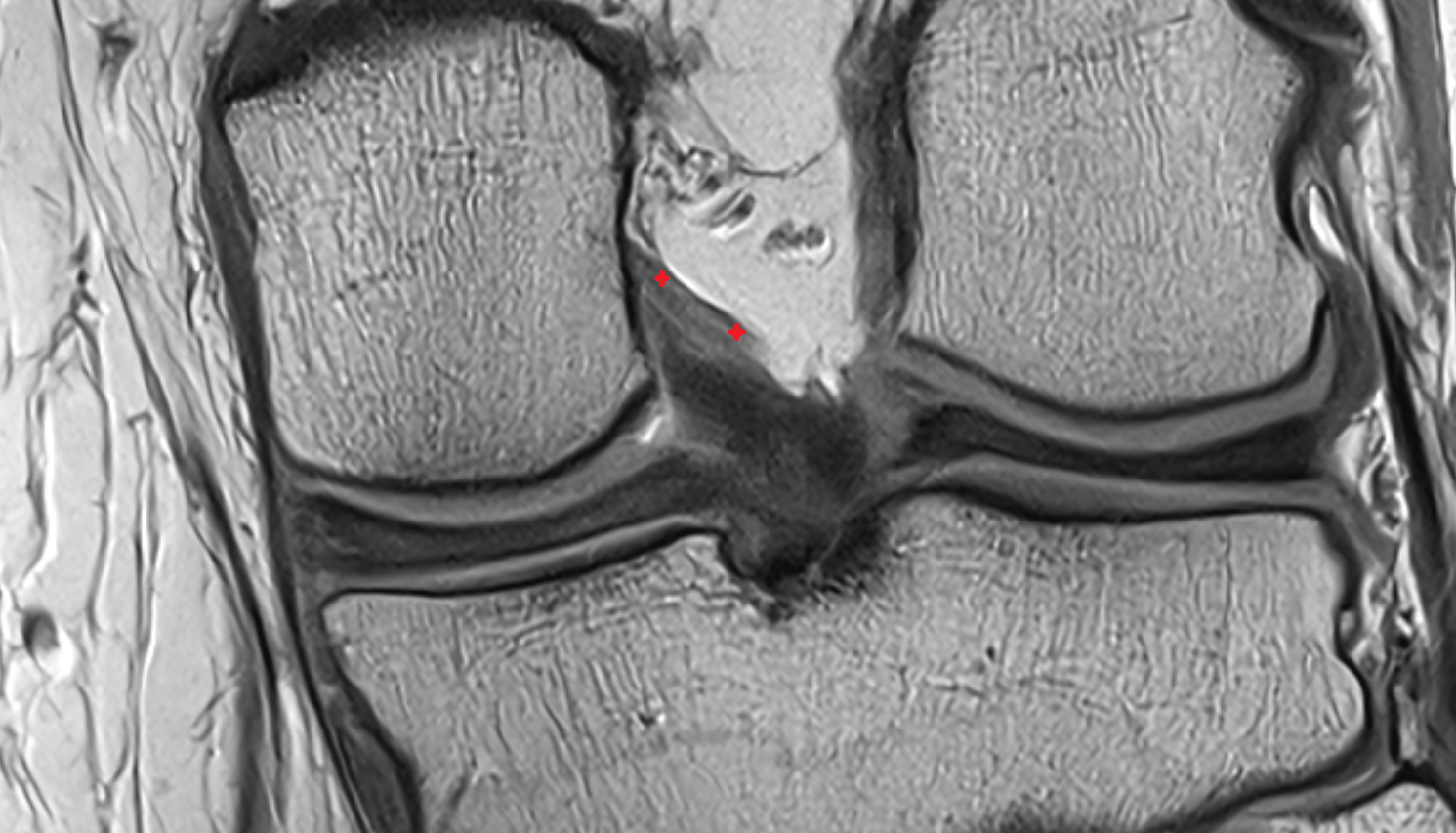 Posterior meniscofemoral ligament (Wrisberg) coronal cross sectional anatomy 3T MRI AI enhanced  radiology  anatomy image-img-00000-00000