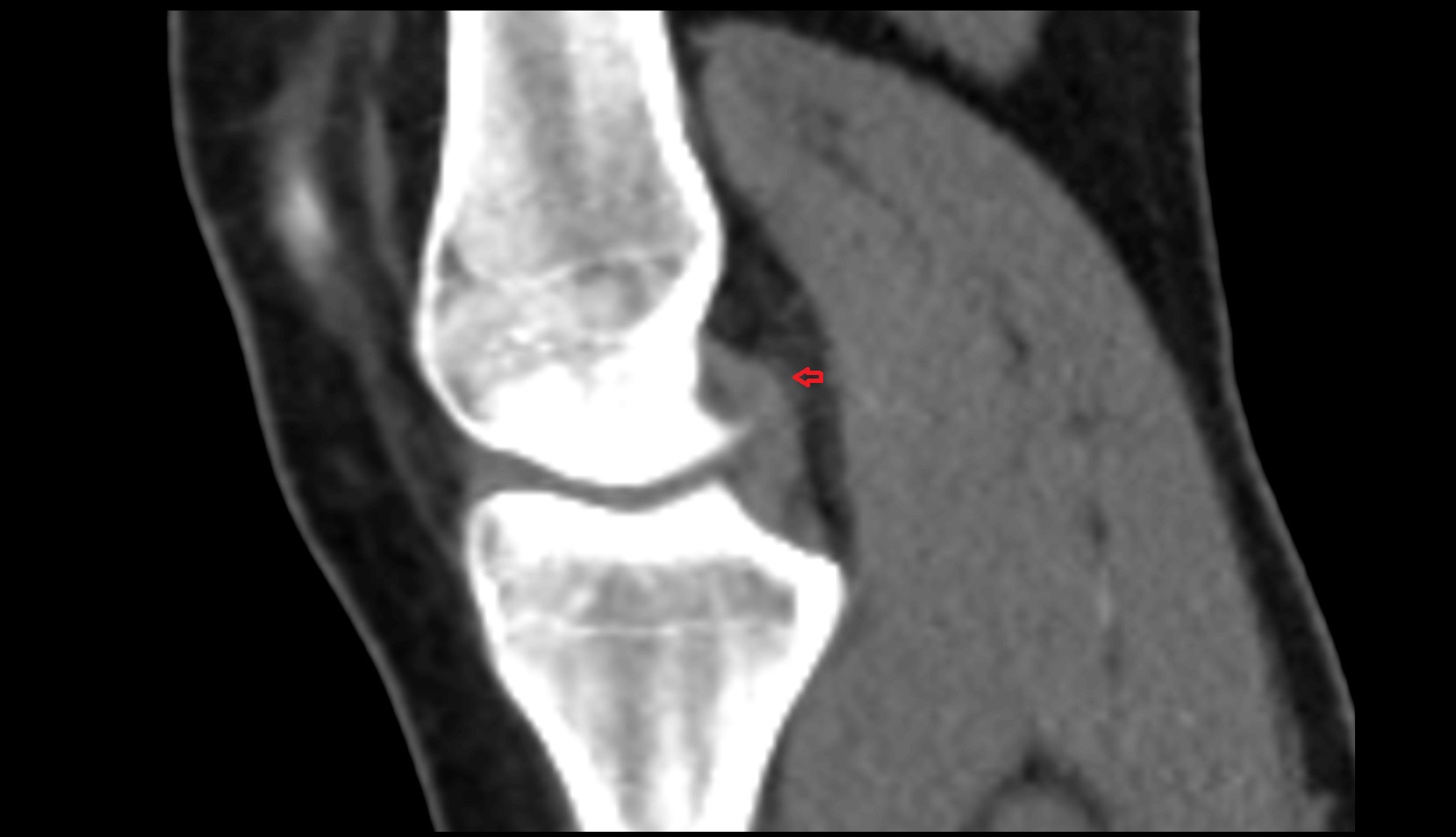 Posterior meniscofemoral ligament (Wrisberg) ct sagittal image