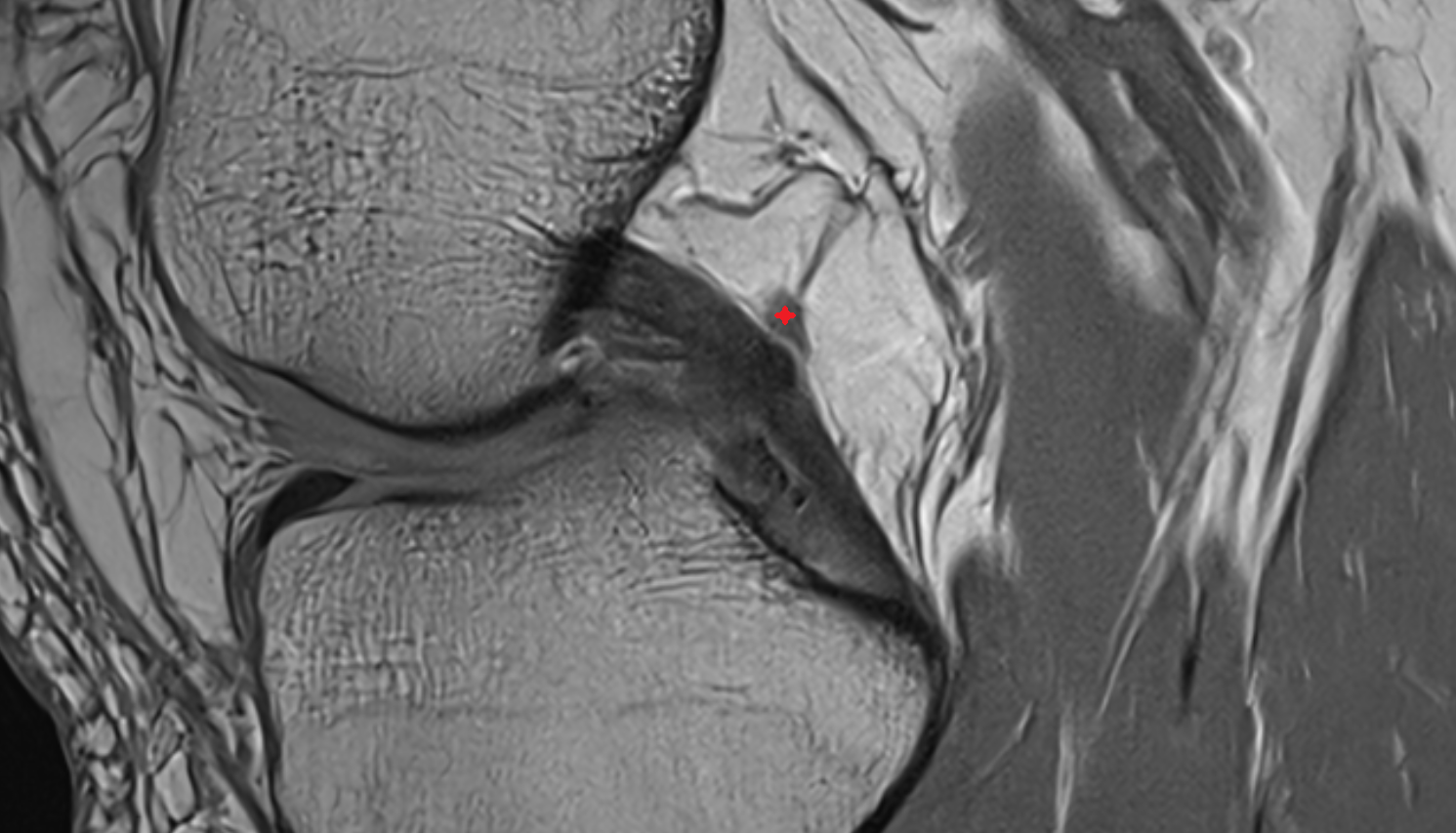 Posterior meniscofemoral ligament (Wrisberg) sagittal cross sectional anatomy 3T MRI AI enhanced  radiology  anatomy image-img-00000-00000