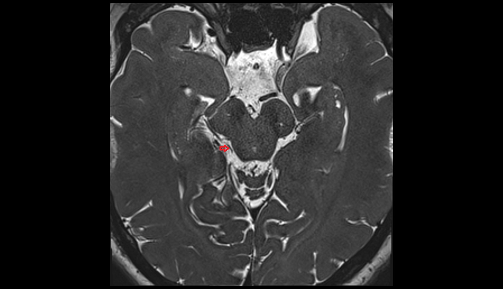Posterior mesencephalic vein MRI 3T axial image