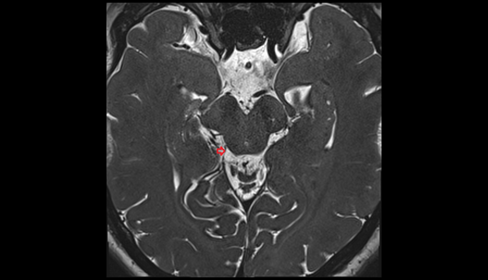 Posterior mesencephalic vein MRI 3T axial image 1