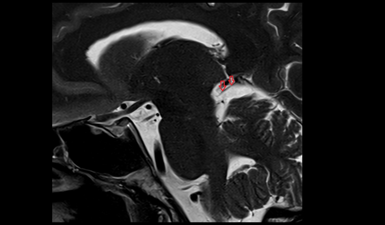 Posterior mesencephalic vein MRI 3T sagittal image