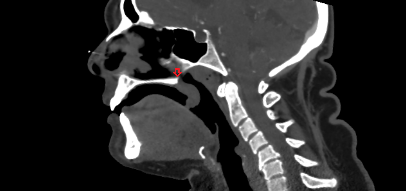 Posterior nasal spine CT  anatomy labelled image-img-00000-00000