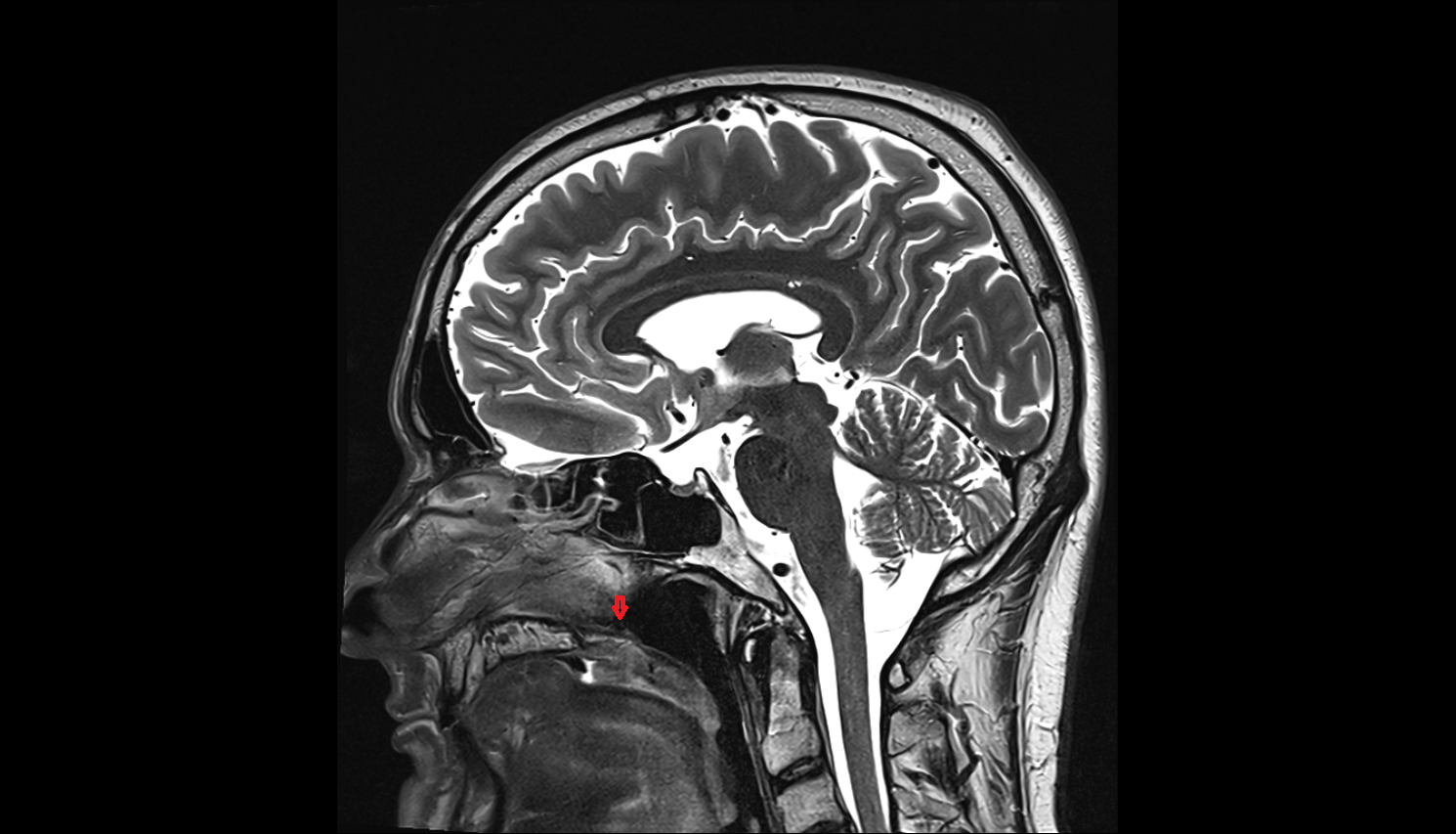 Posterior nasal spine MRI  anatomy labelled image-img-00000-00000