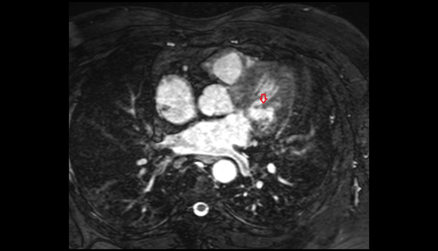 Posterior papillary muscle mri image