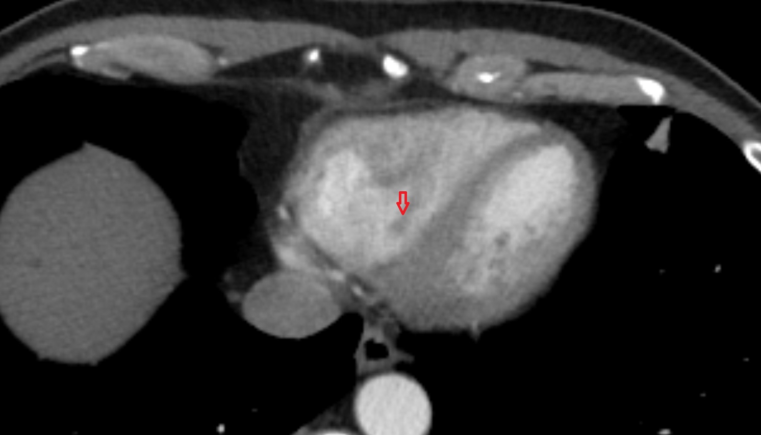 Posterior papillary muscle of rt ventricle anatomy CT axial image -img-00000-00000