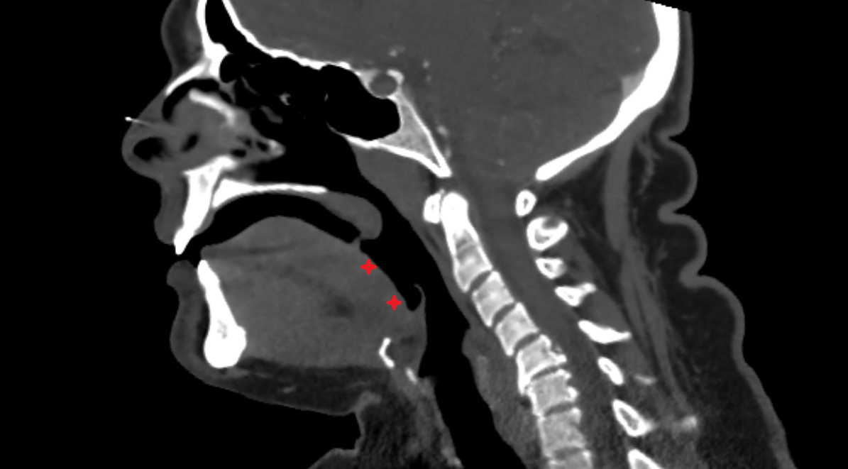 Posterior part of tongue CT  anatomy labelled image-img-00000-00000