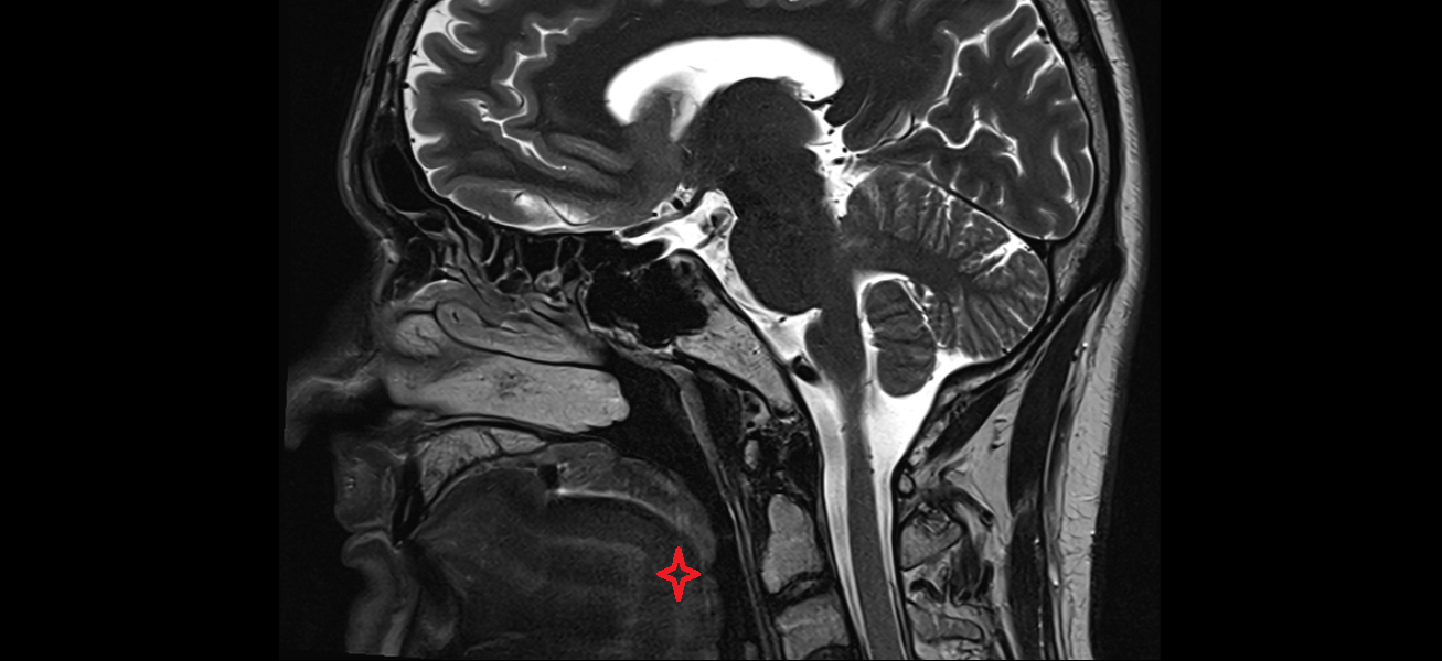 Posterior part of tongue MRI  anatomy labelled image-img-00000-00000