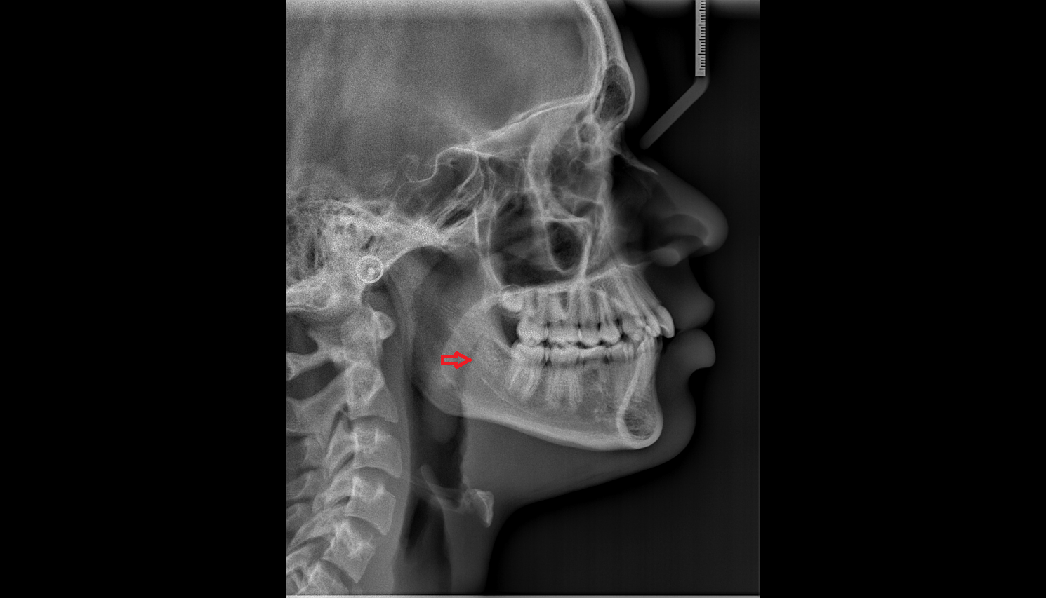 Posterior part of tongue X RAY  anatomy labelled image-img-00000-00000