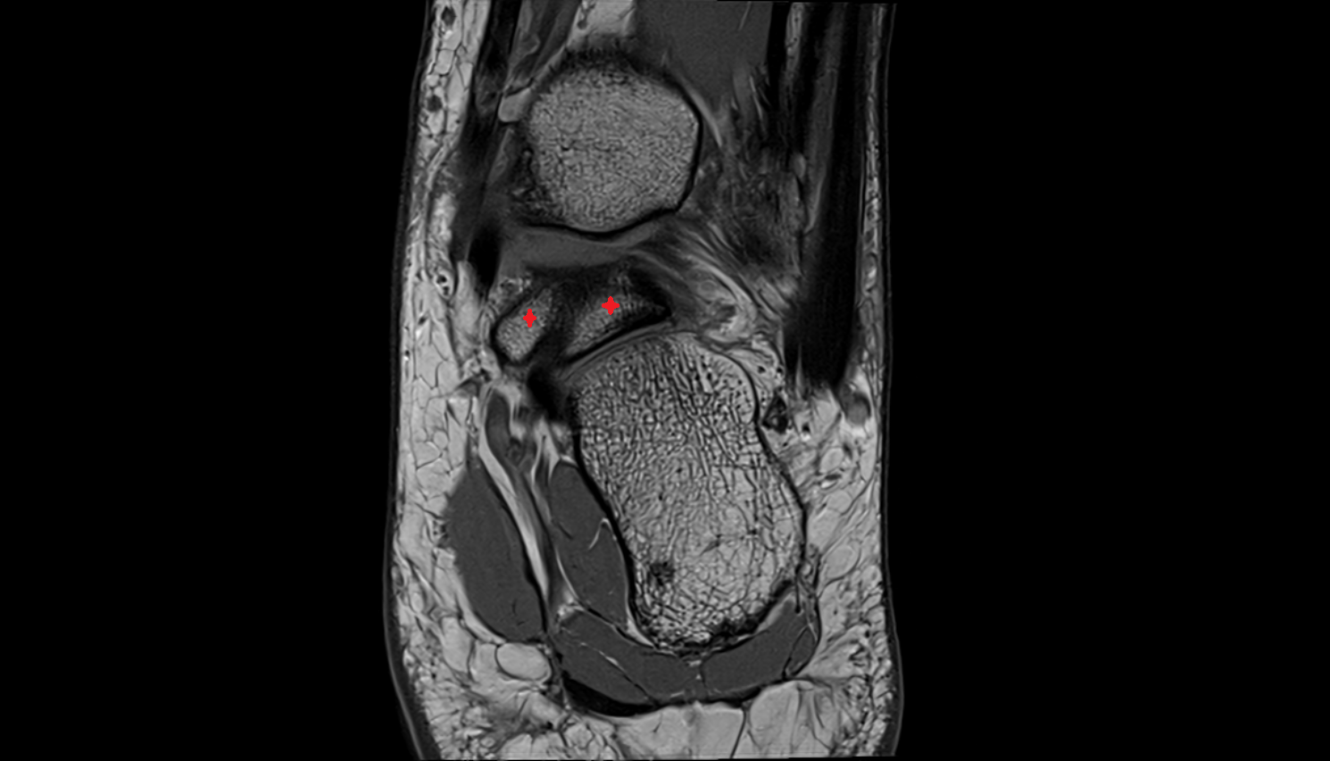 Posterior process of talus  mri  anatomy labelled image-img-00000-00000