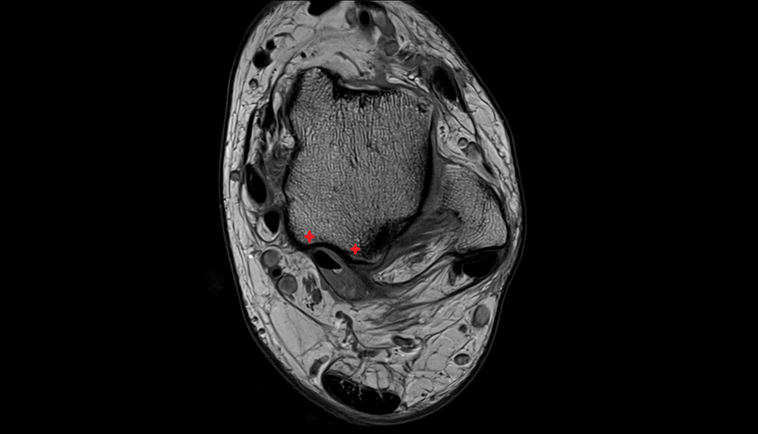 Posterior process of talus  mri  anatomy labelled image-img-00000-00000_00001