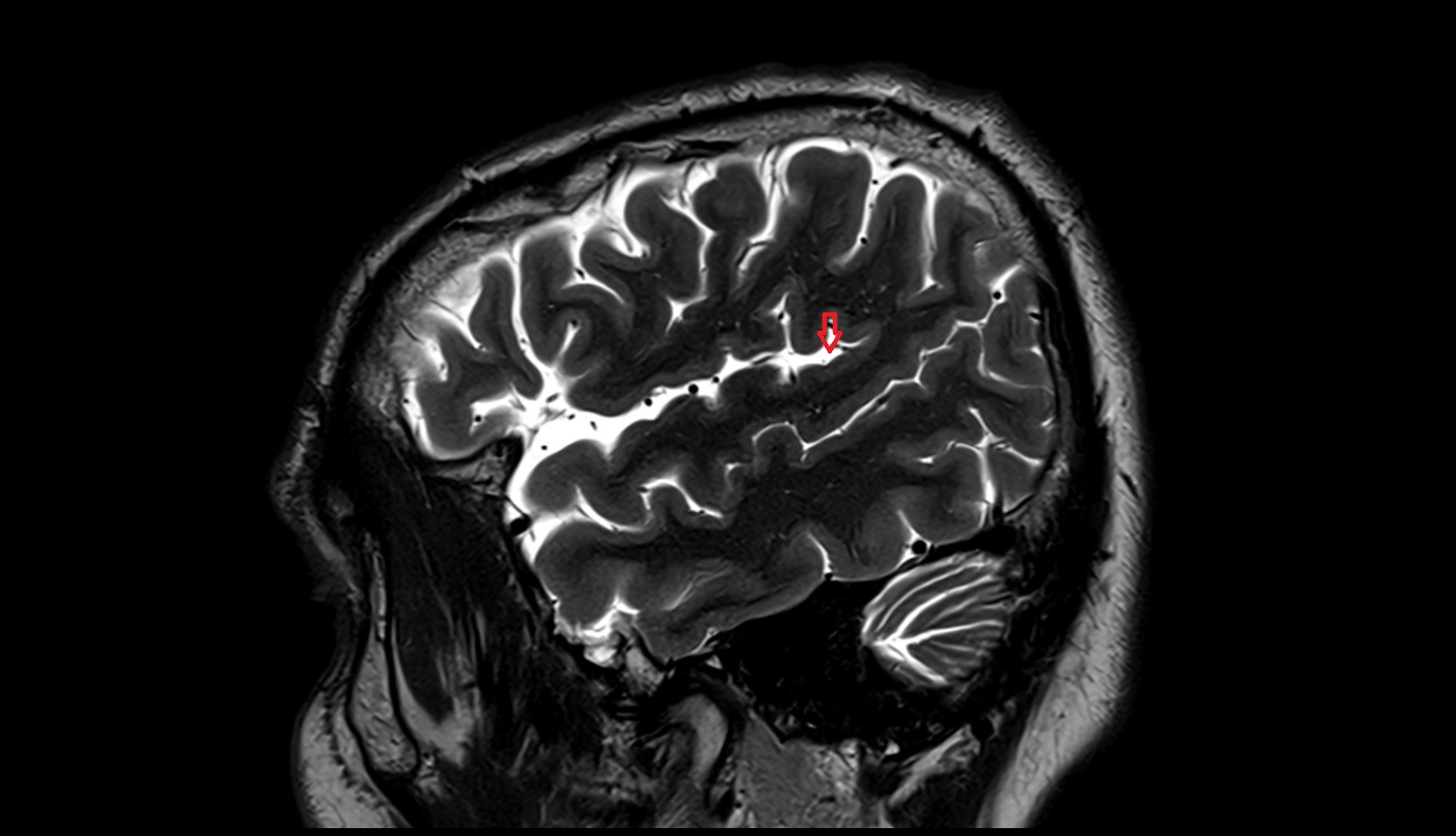 Posterior ramus of lateral sulcus MRI 3T sagittal image
