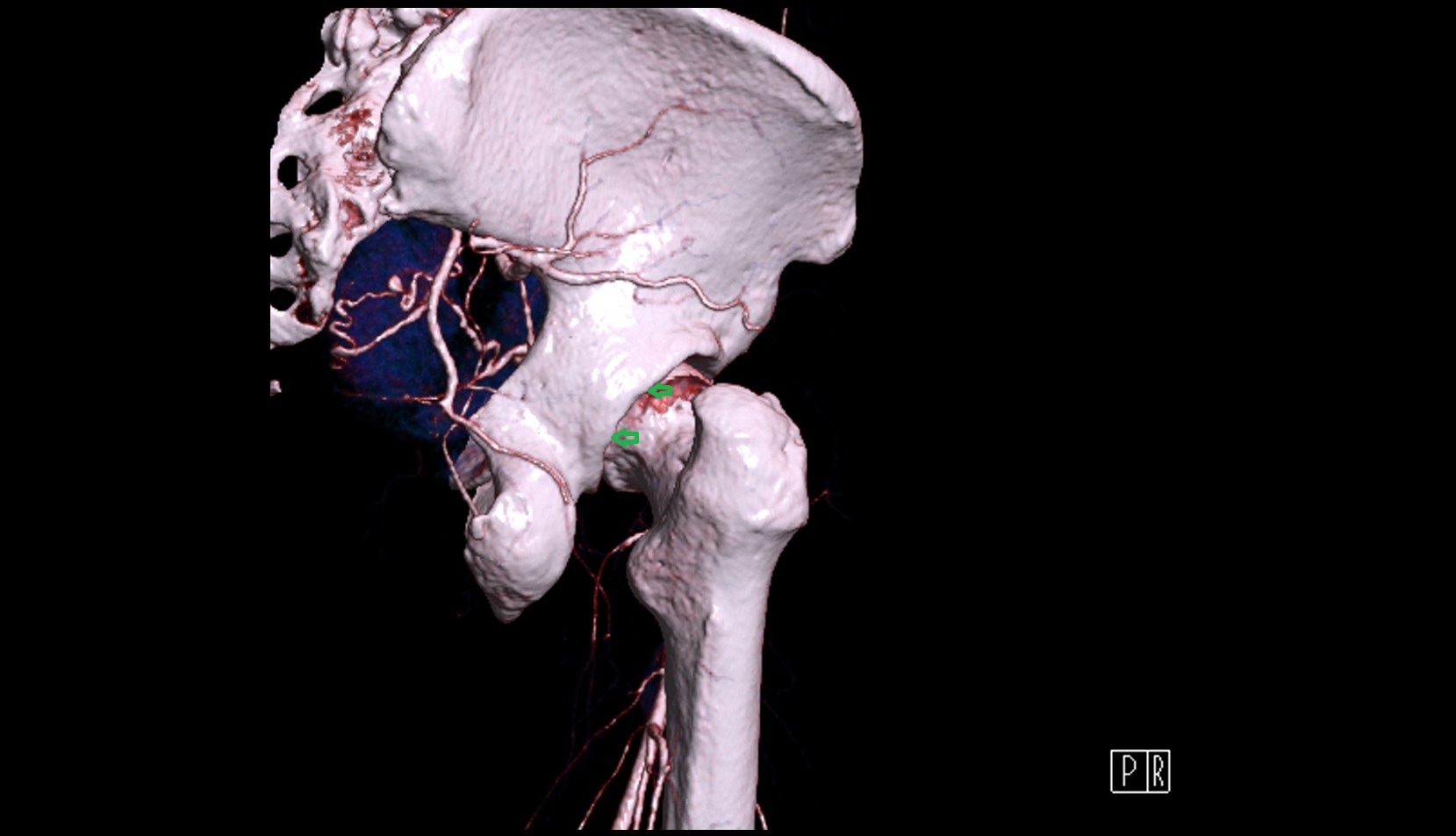 Posterior rim of acetabulum 3d