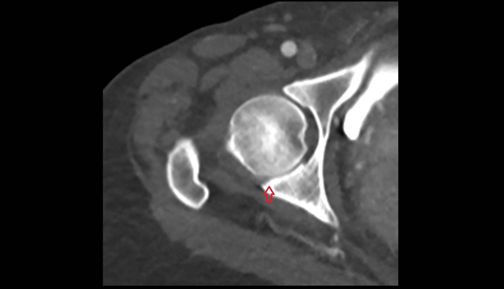Posterior rim of acetabulum ct axial