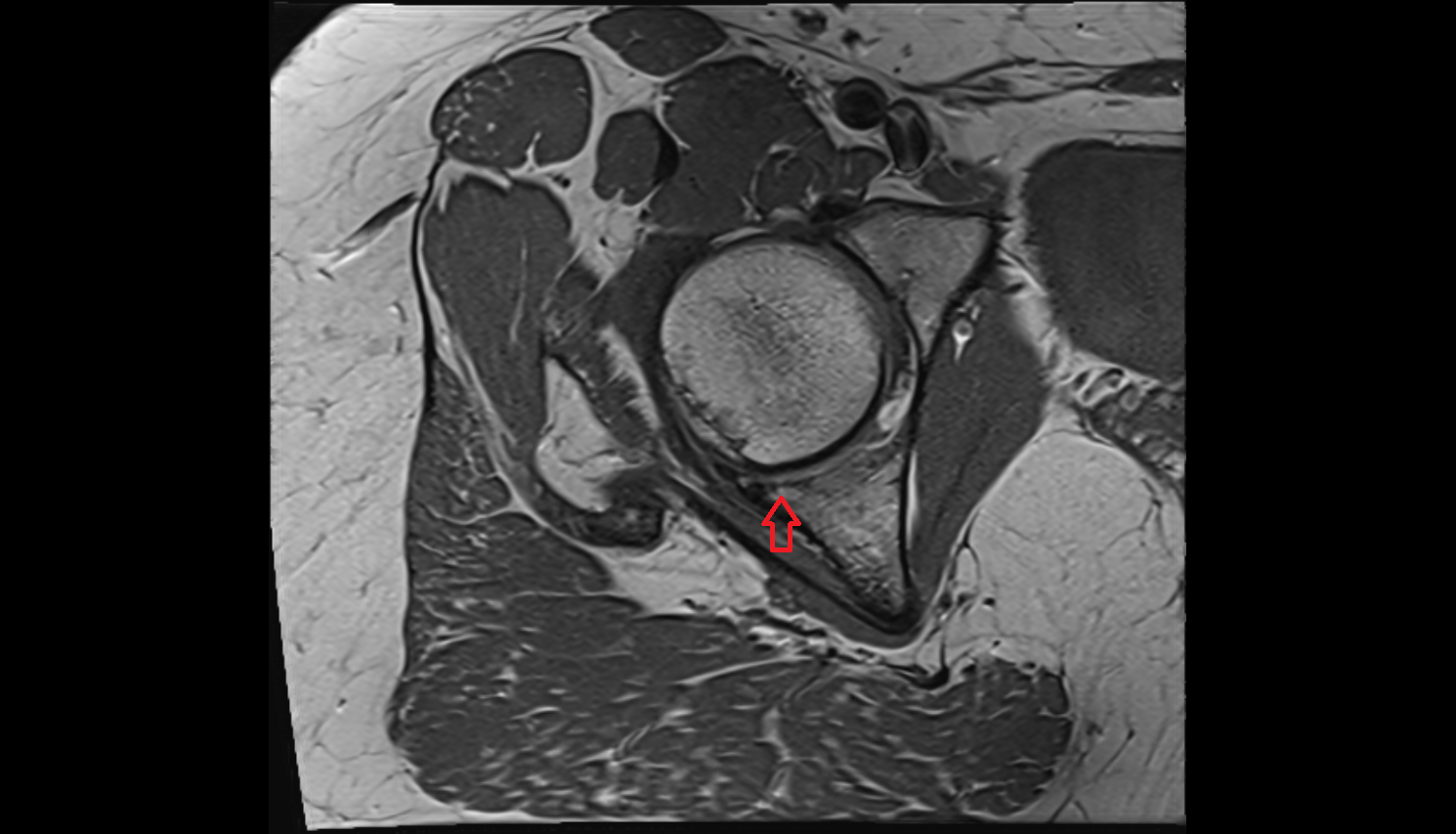 Posterior rim of acetabulum  mri  anatomy labelled image-img-00000-00000