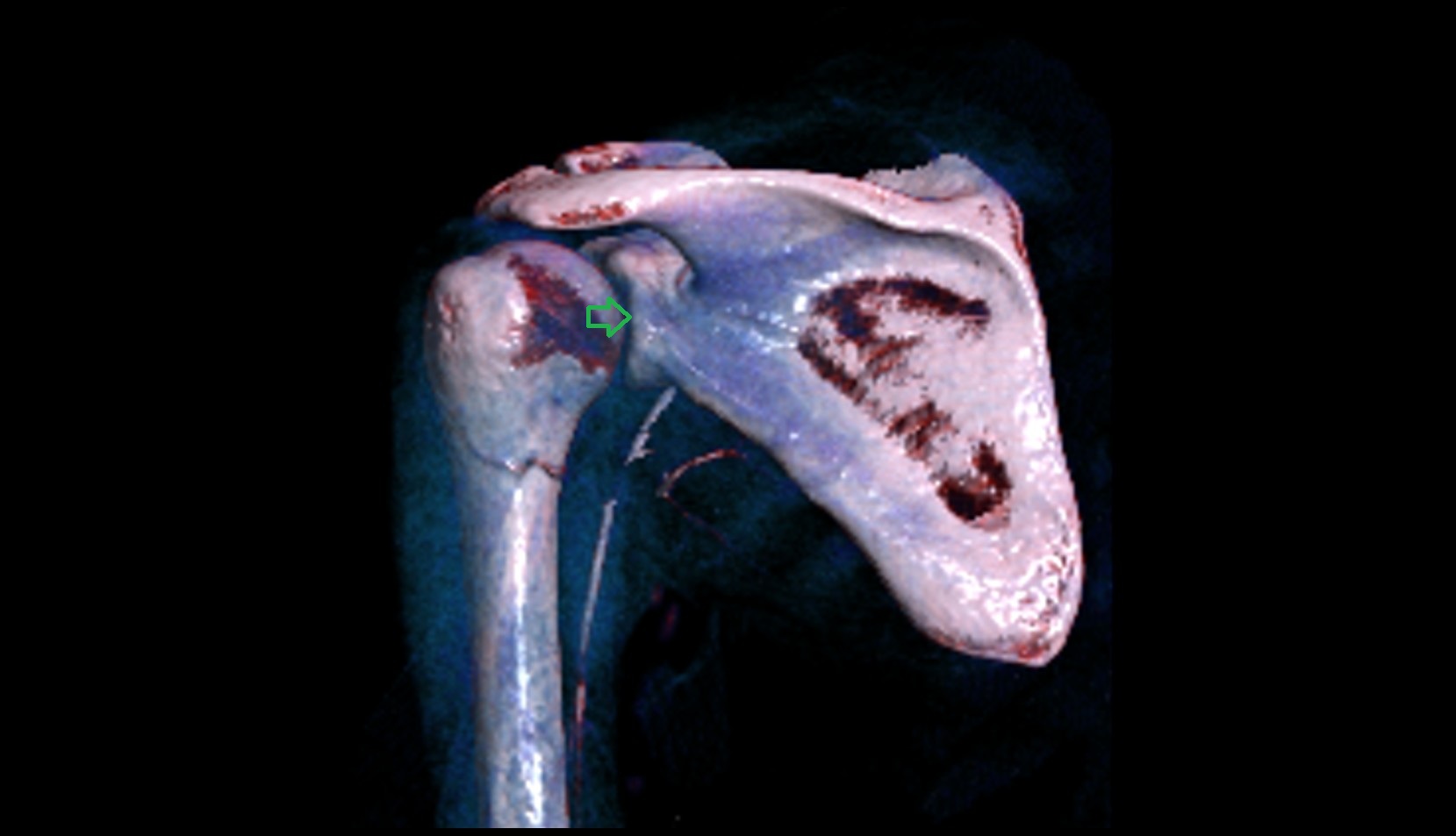 Posterior rim of glenoid