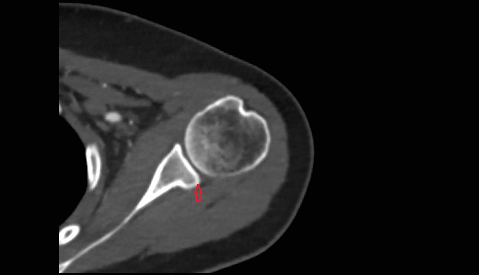 Posterior rim of glenoid ct