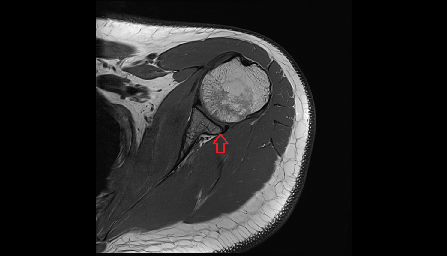 Posterior rim of glenoid mri  anatomy labelled image-img-00000-00000