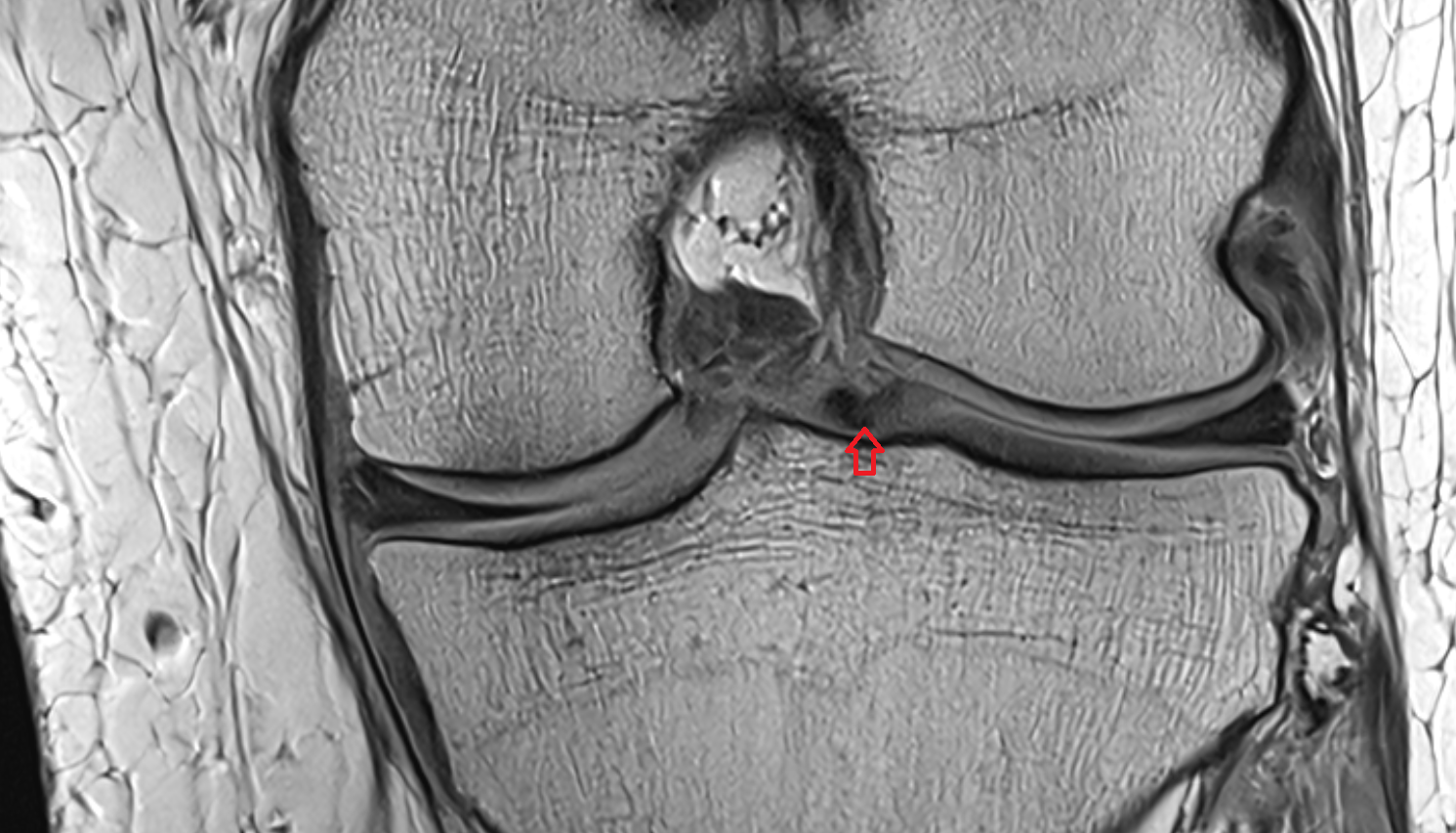 Posterior root of lateral meniscus  coronal  cross sectional anatomy 3T MRI AI enhanced  radiology  anatomy image-img-00000-00000