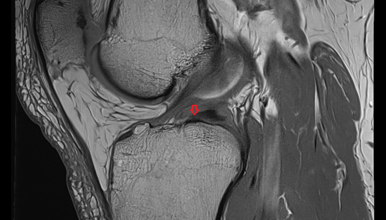 Posterior root of lateral meniscus  sagittal  cross sectional anatomy 3T MRI AI enhanced  radiology  anatomy image-img-00000-00000