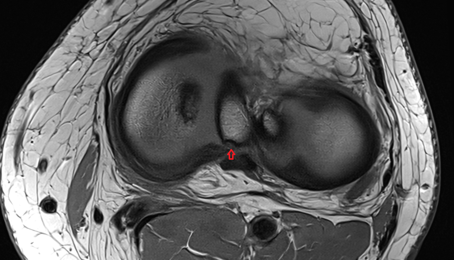 Posterior root of medial meniscus  axial  cross sectional anatomy 3T MRI AI enhanced  radiology  anatomy image-img-00000-00000