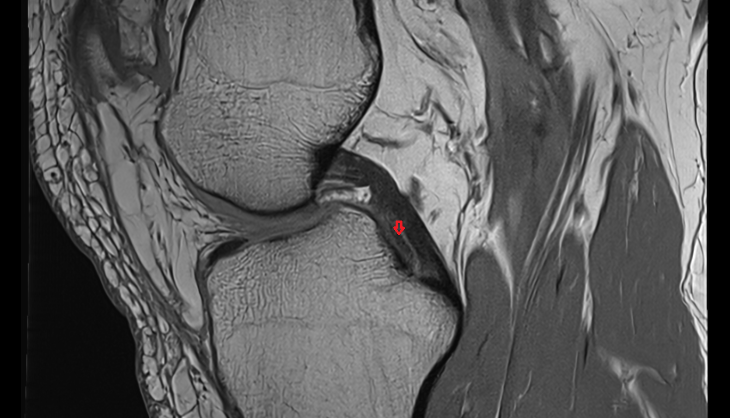 Posterior root of medial meniscus  sagittal  cross sectional anatomy 3T MRI AI enhanced  radiology  anatomy image-img-00000-00000_00001