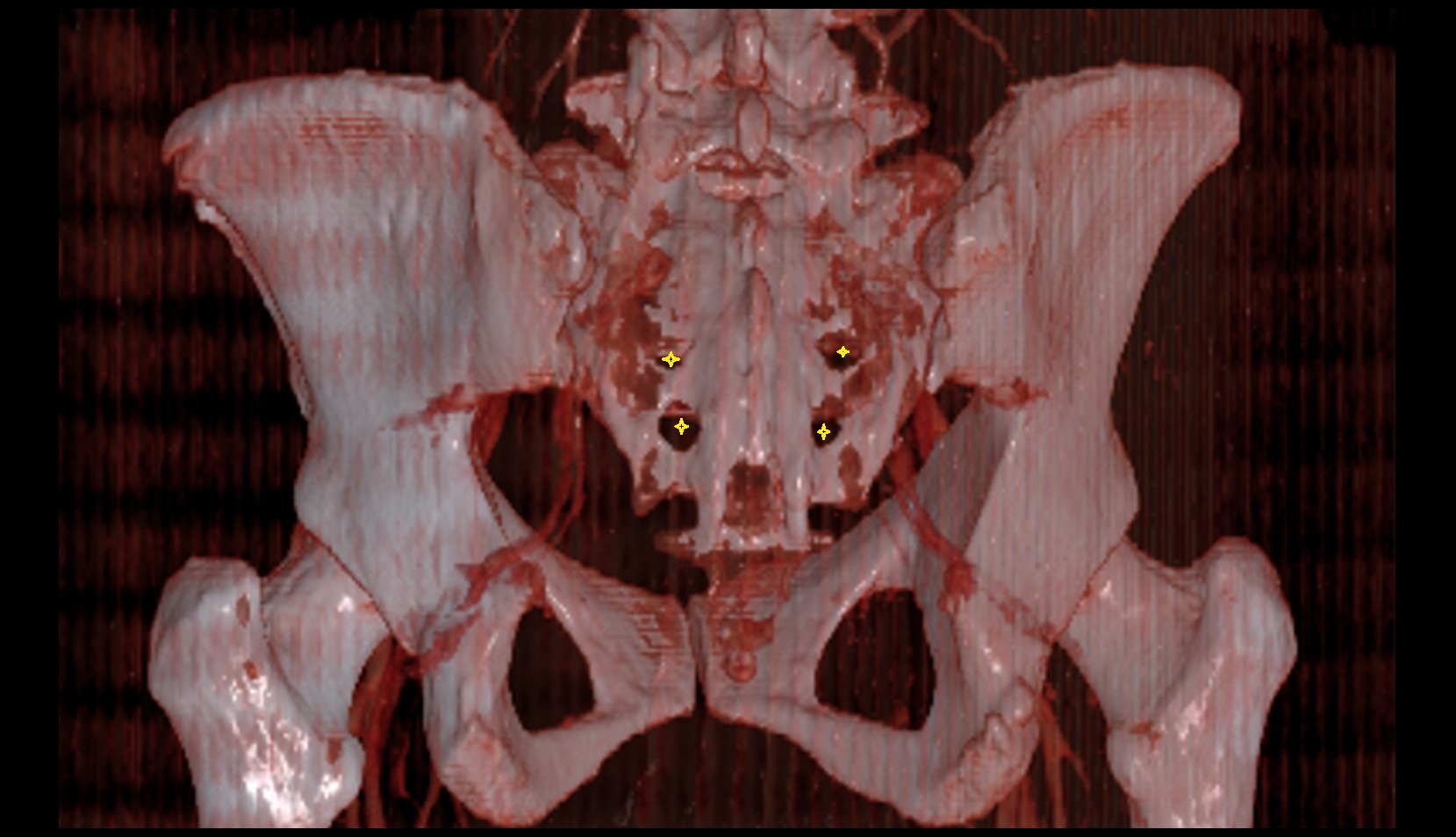 Posterior sacral foramina 3d ct image