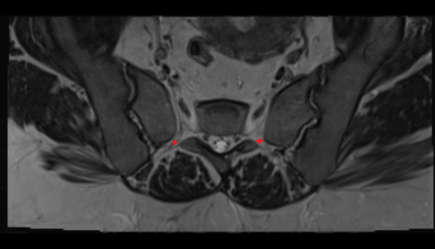 Posterior sacral foramina  MRI axial anatomy  image -img-00000-00000
