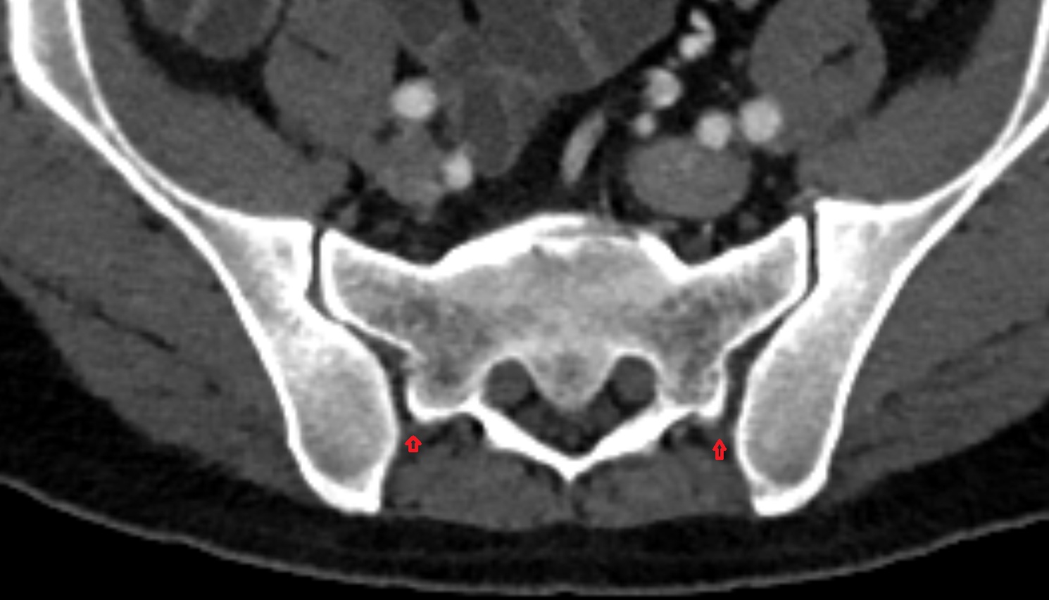 Posterior sacroiliac ligament ct axial image