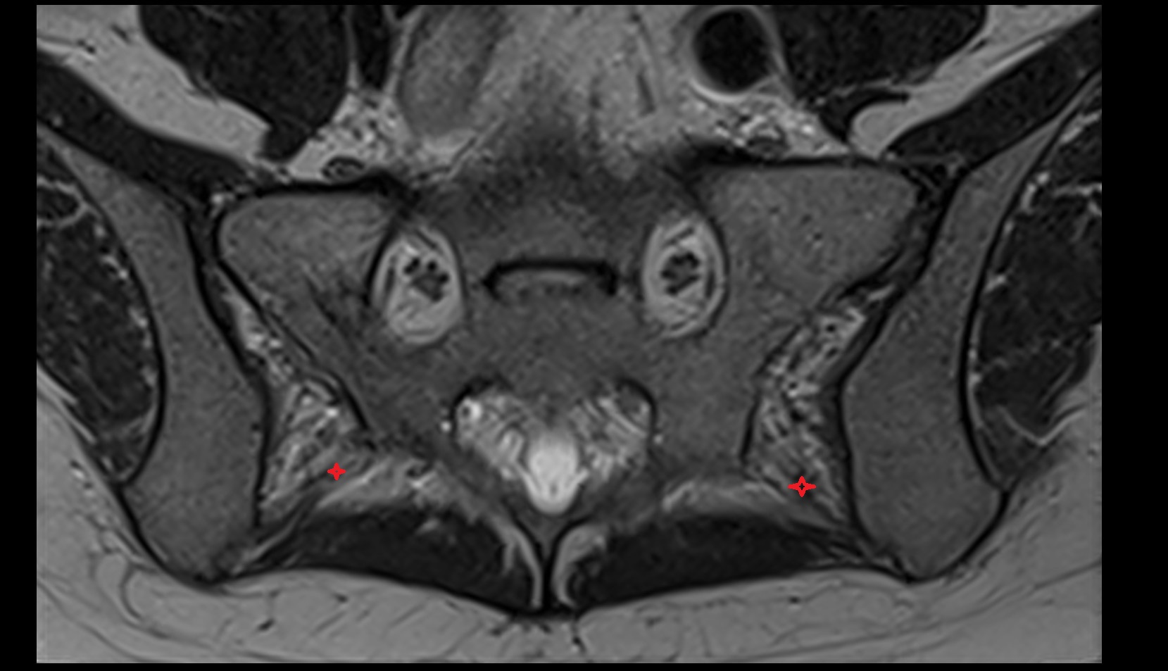 Posterior sacroiliac ligament mri axial image