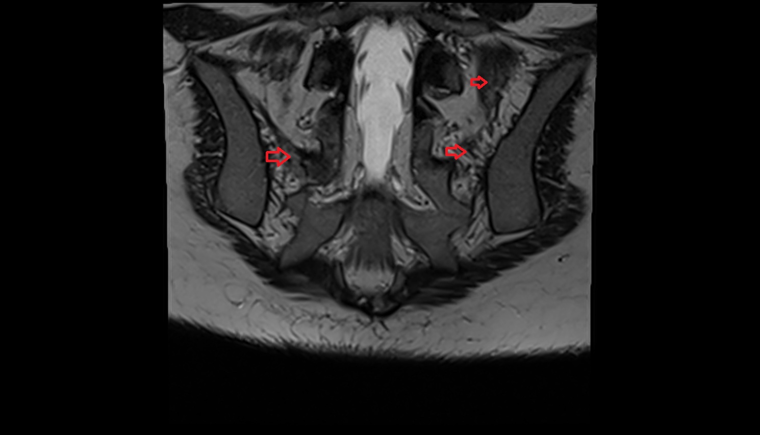 Posterior sacroiliac ligament   mri coronal  anatomy  image-img-00000-00000
