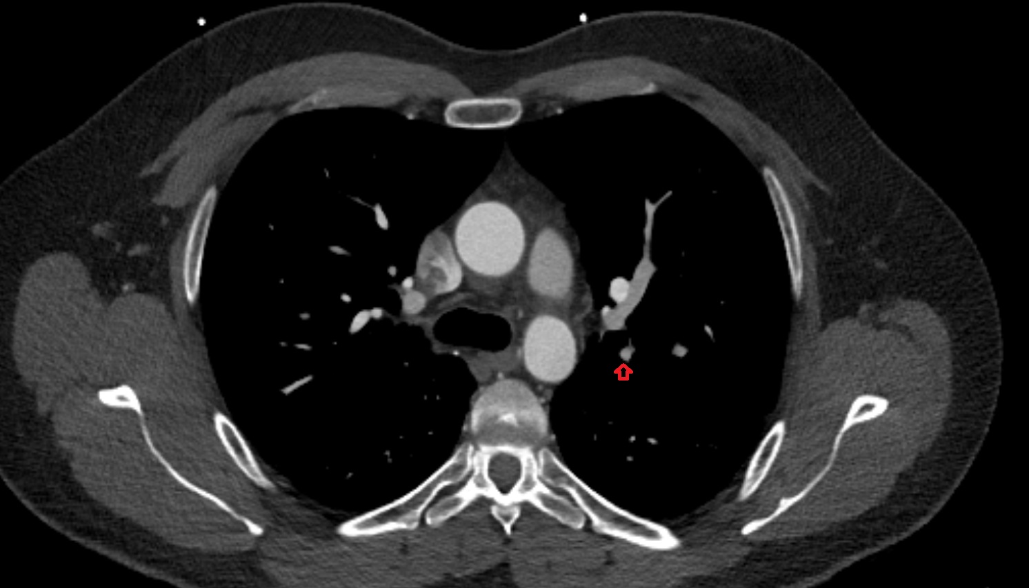 Posterior segmental artery of left lung   anatomy ct axial  image -img-00000-00000