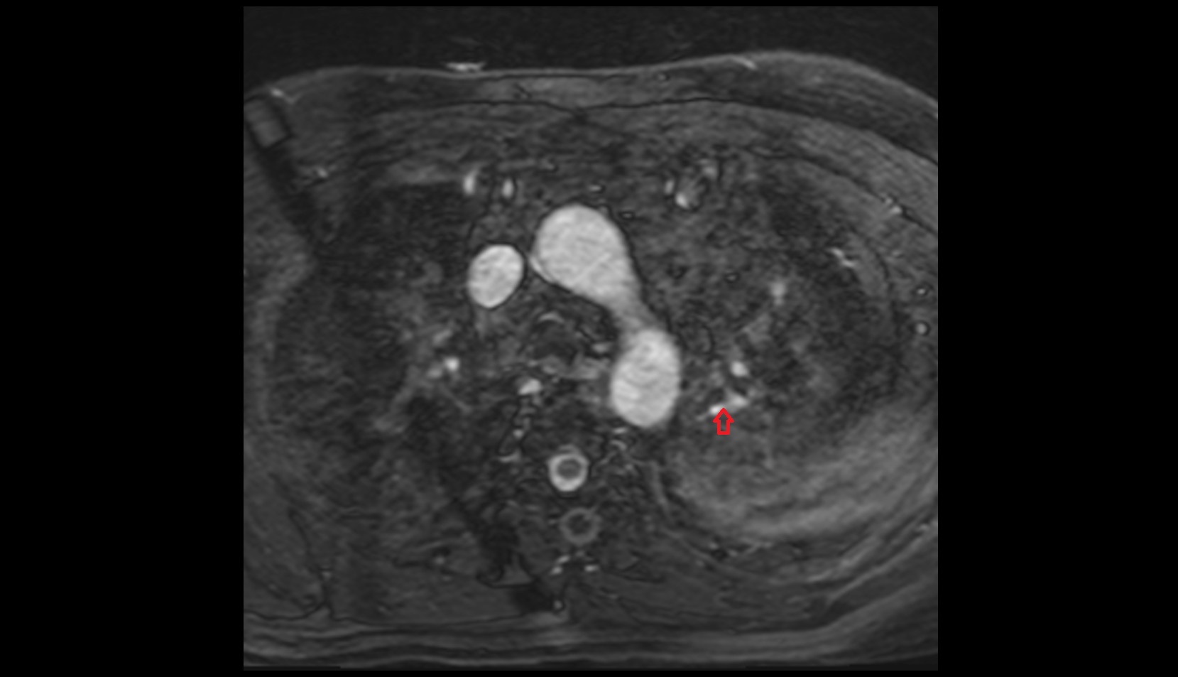 Posterior segmental artery of left lung  mri image