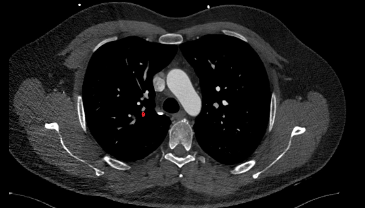 Posterior segmental artery of right lung   anatomy ct axial  image -img-00000-00000