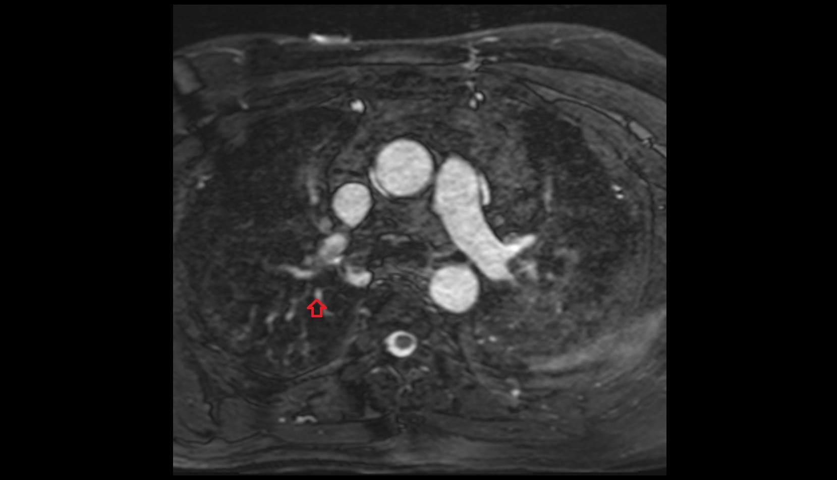 Posterior segmental artery of right lung  mri image