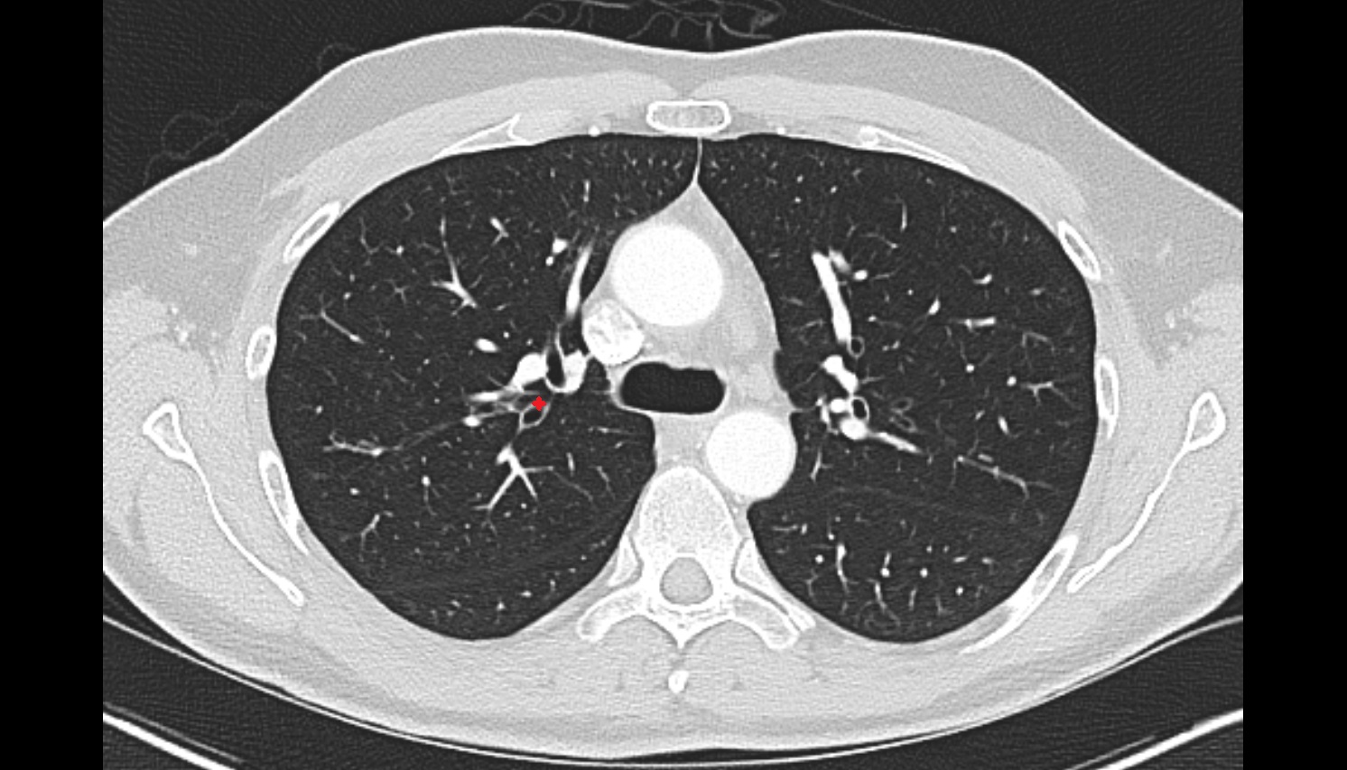 Posterior segmental bronchus of right lung  CT axial image -img-00000-00000