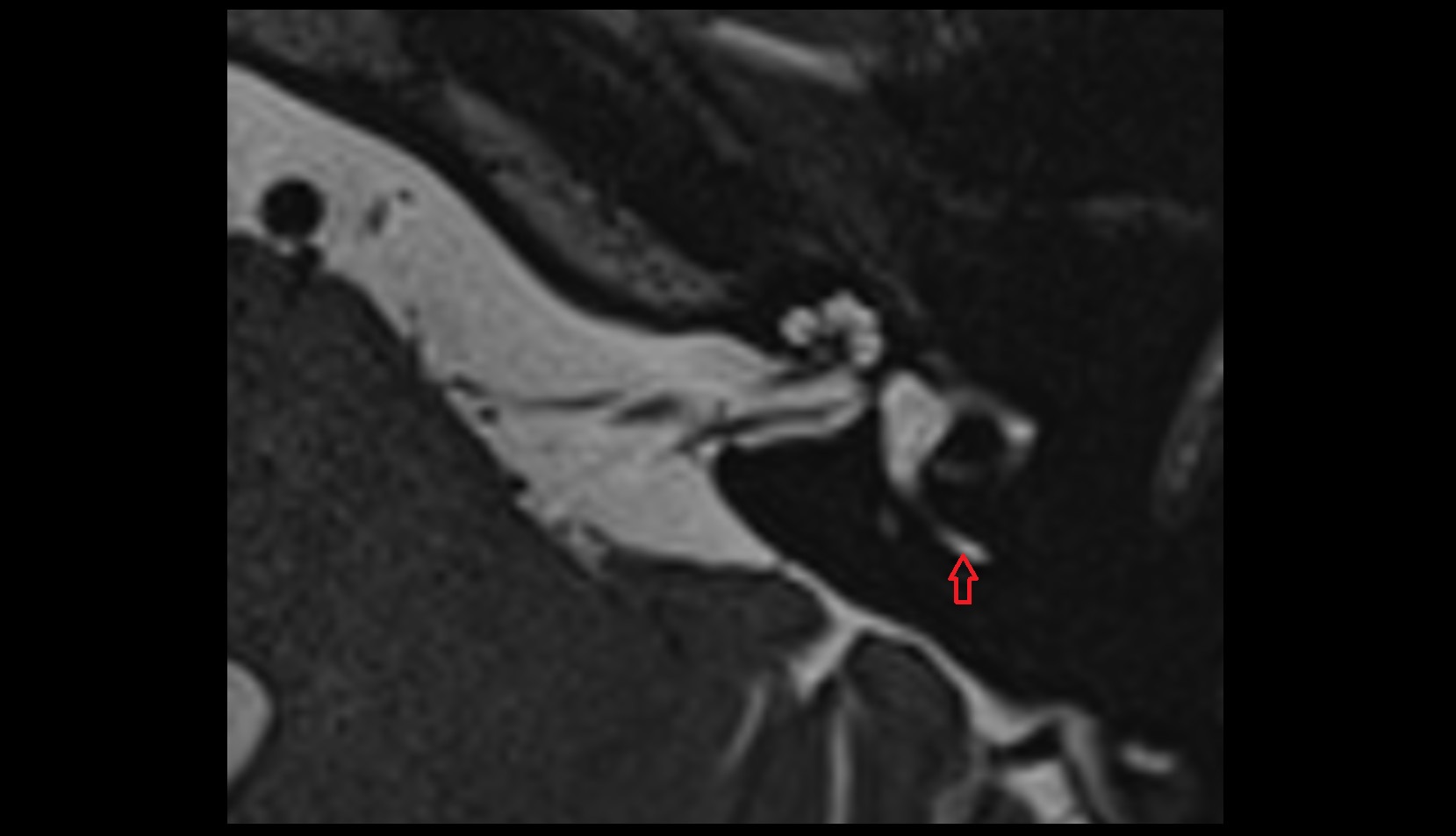 Posterior semicircular canal image 2