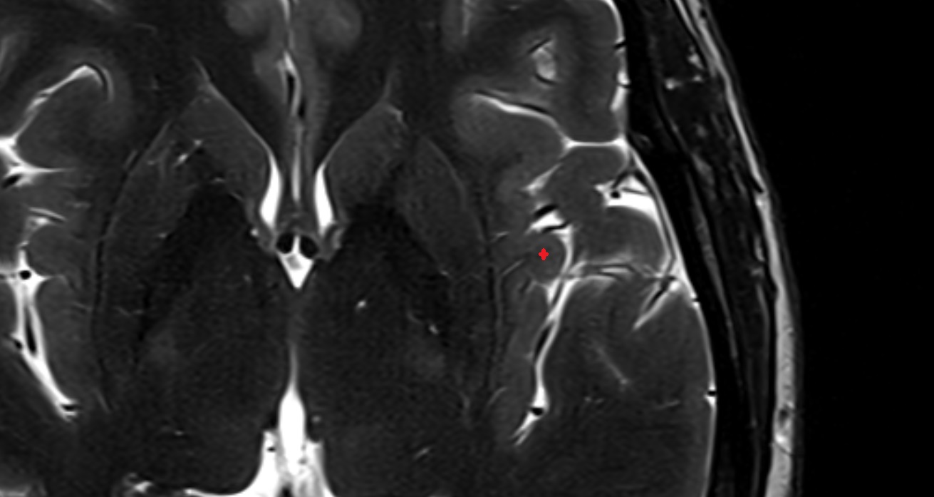 Posterior short insular gyrus mri  axial  anatomy image -img-00001-00001
