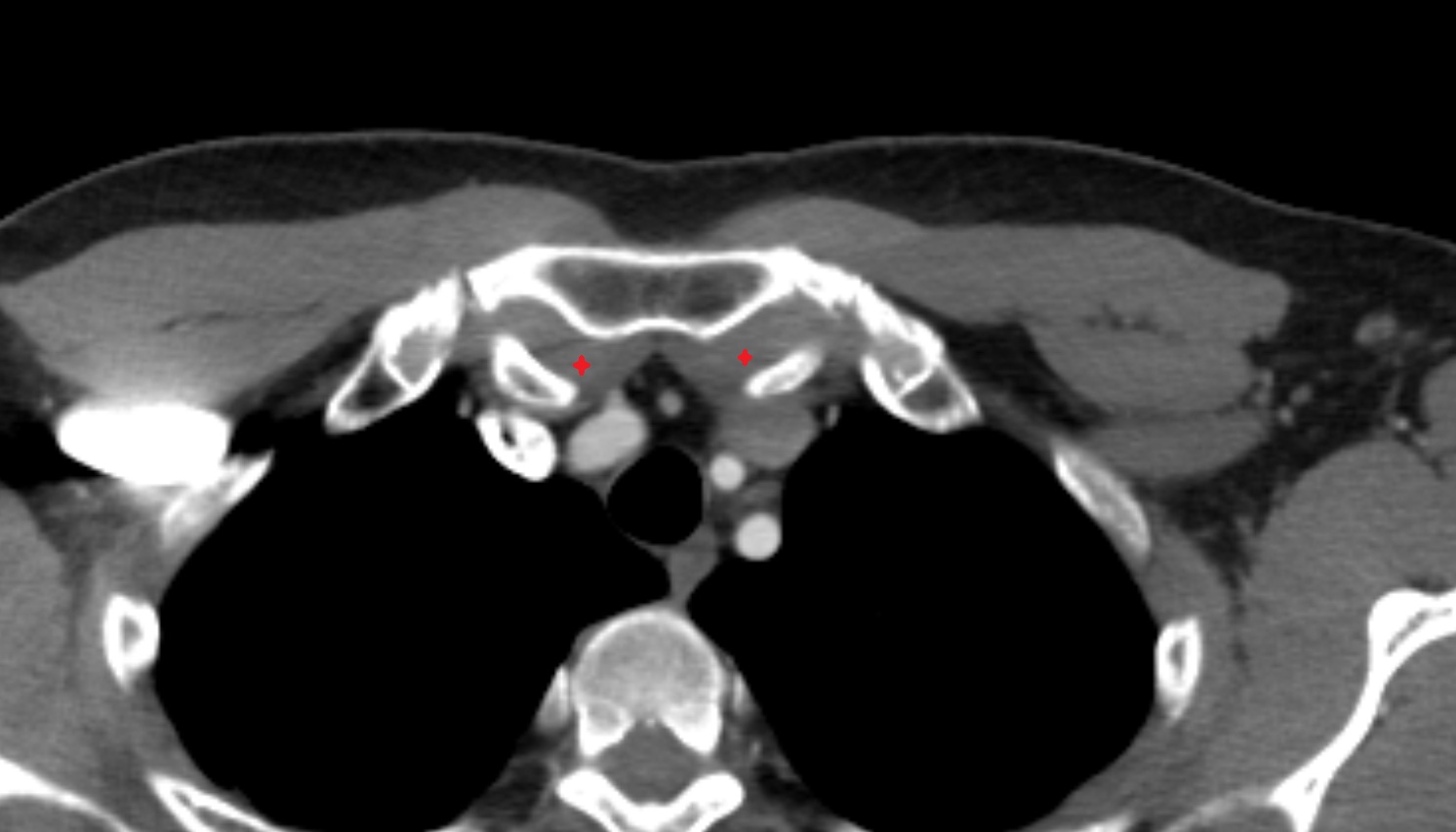 Posterior sternoclavicular ligament  anatomy CT axial  image -img-00000-00000