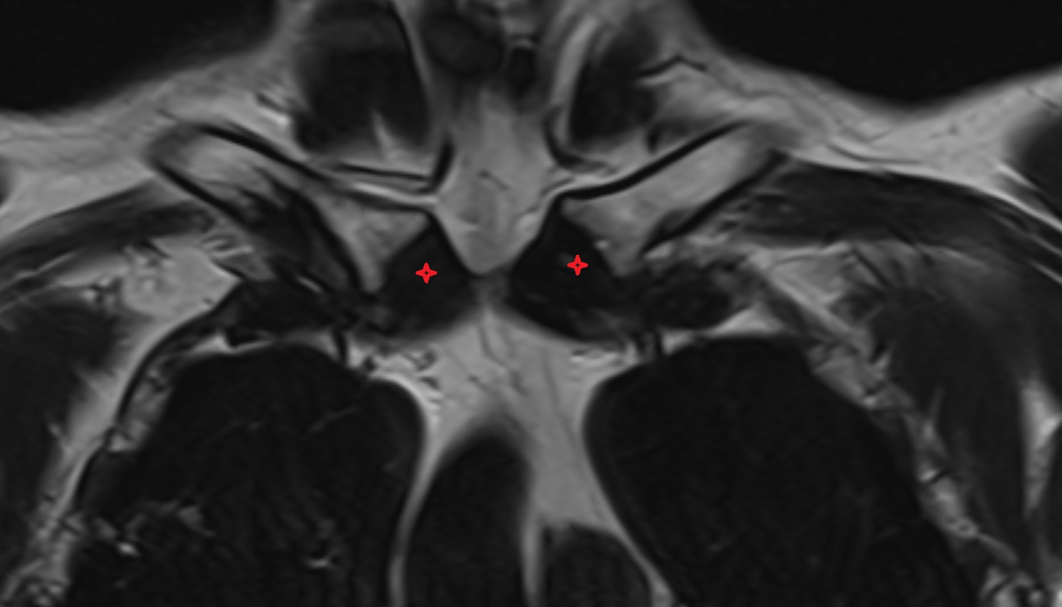 Posterior sternoclavicular ligament  anatomy MRI coronal  image -img-00000-00000
