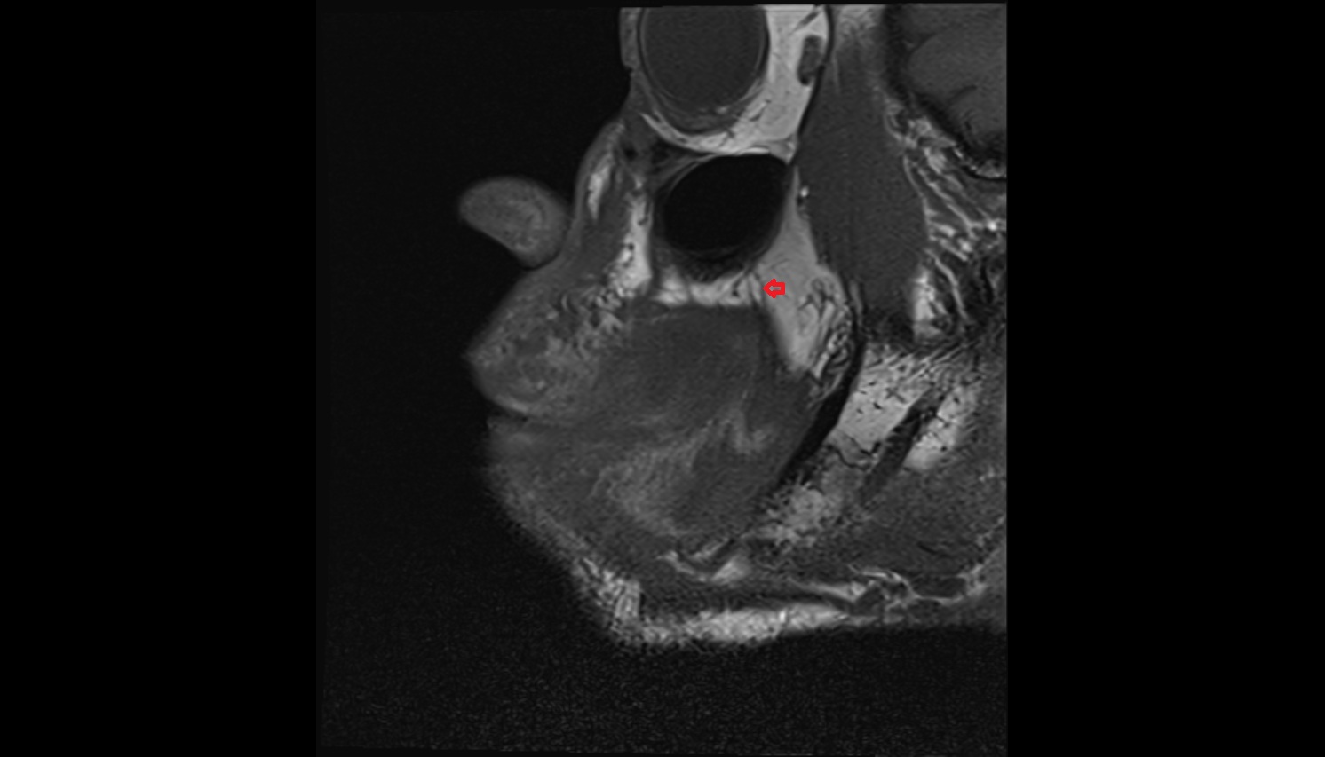 Posterior superior alveolar nerve  mri sagittal  image -img-00000-00000