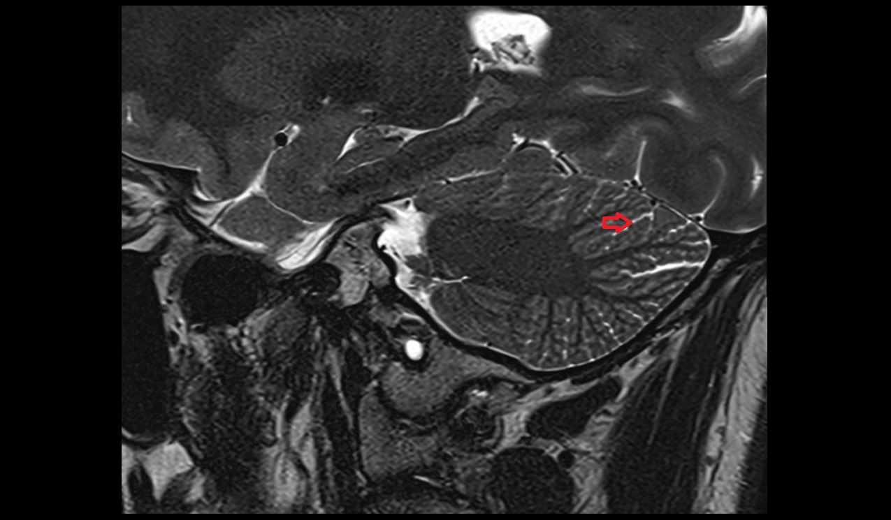Posterior superior fissure MRI 3T sagittal image