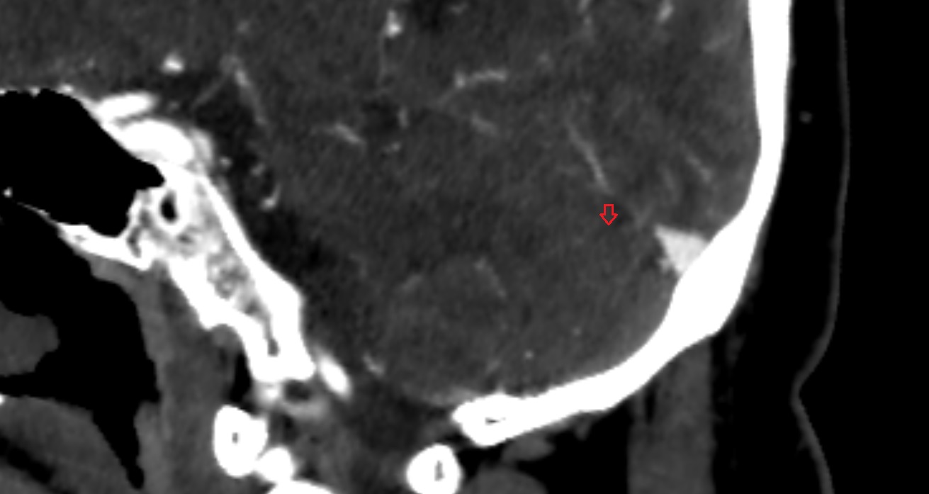Posterior superior fissure of cerebellum  CT sag  anatomy image -img-00001-00001